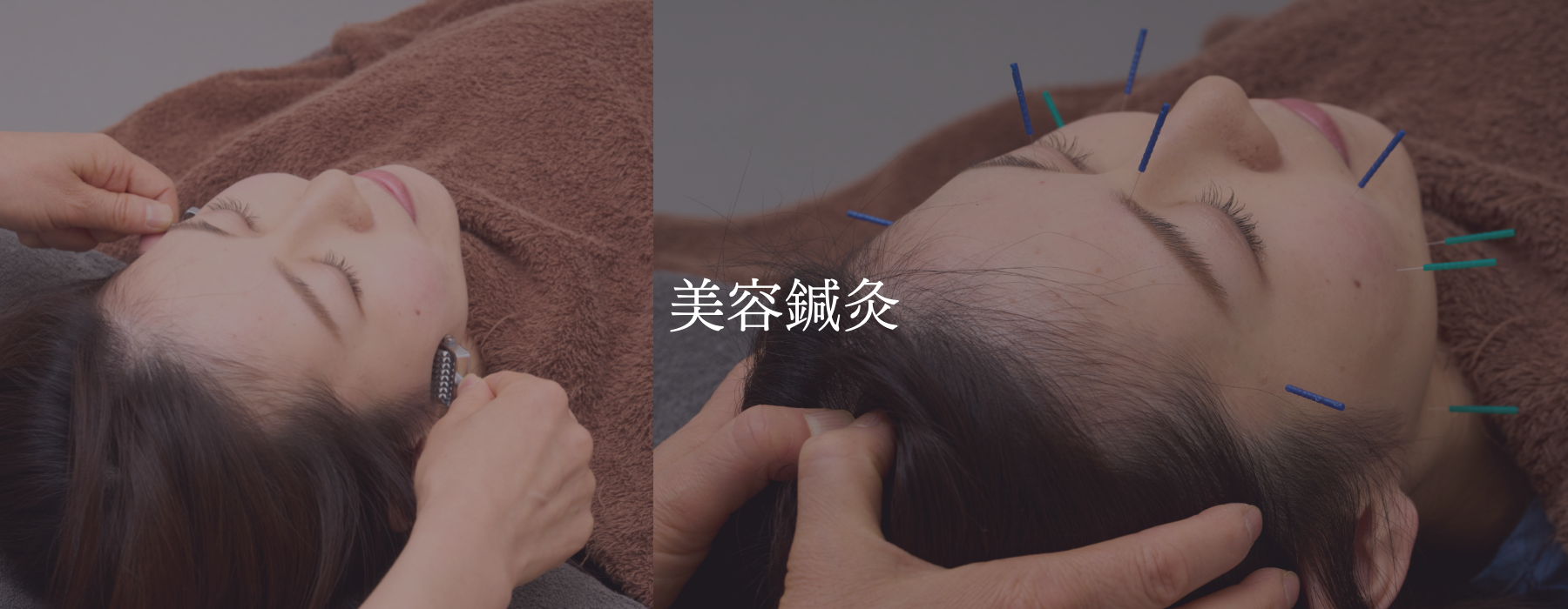 美容鍼灸