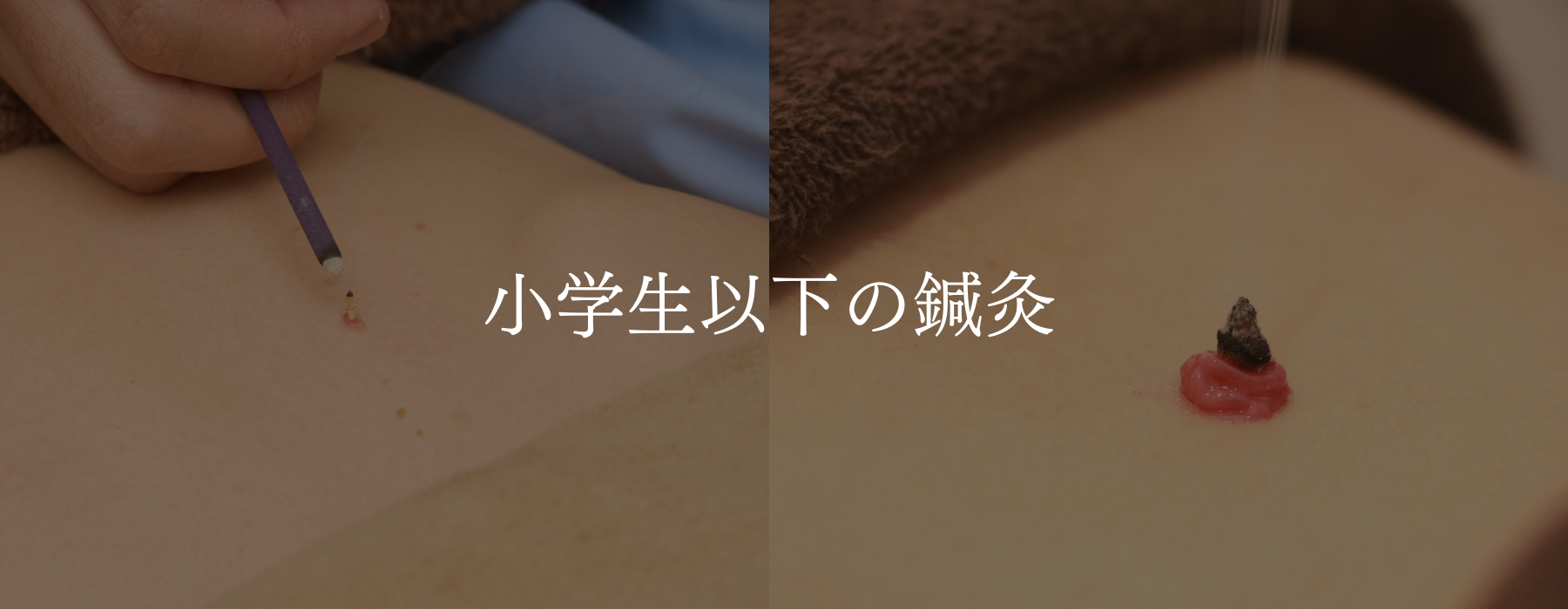 小学生以下の鍼灸